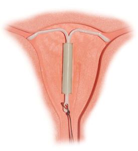 Mirena IntraUterine System.jpg, foto: Hic et nunc, wikipedia