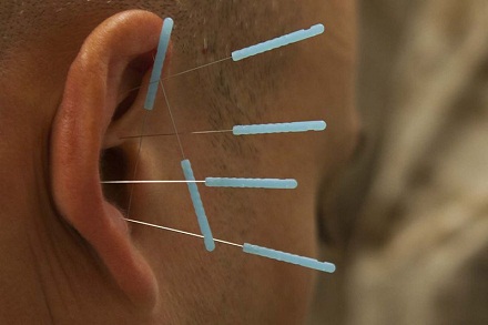  Acupuncture